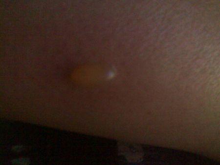 我小腿上长的是什么疱疹啊