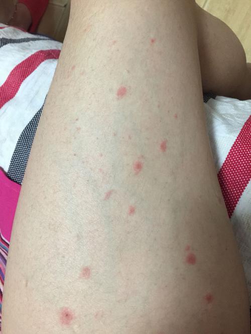 问:腿上起了一些小红点 不疼不痒的 而且越来越多 刚开始做腿 后来
