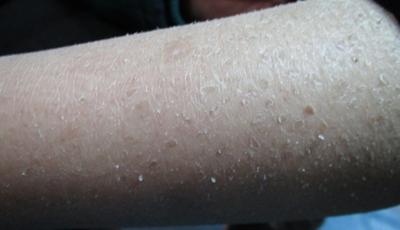 小儿鱼鳞病怎么治