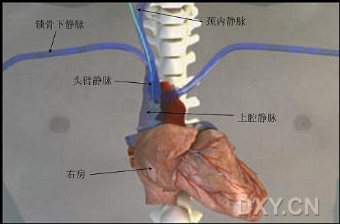 《新英格兰医学杂志》最新综述:中心静脉置管规范