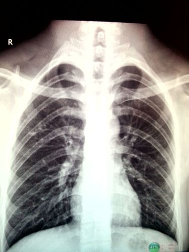 3年9月检查出来肺结核,但是不咳嗽,只是背部疼痛.
