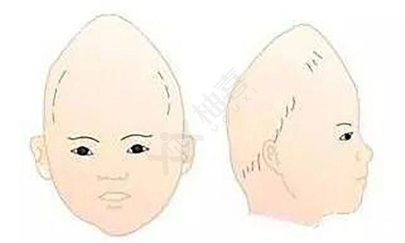 1p36缺失综合征会导致小头畸形