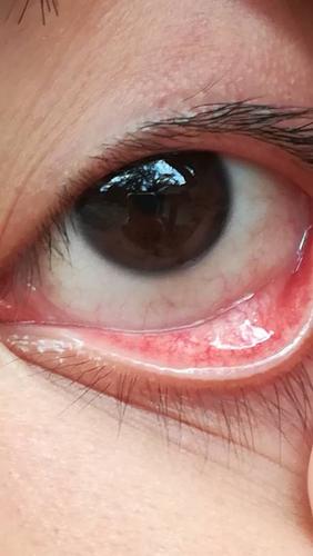 眼睛有血丝有异物感啊怎么办?