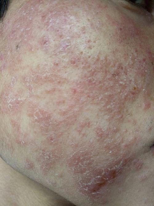 大家帮我看看,本人前段时间脸上皮炎.