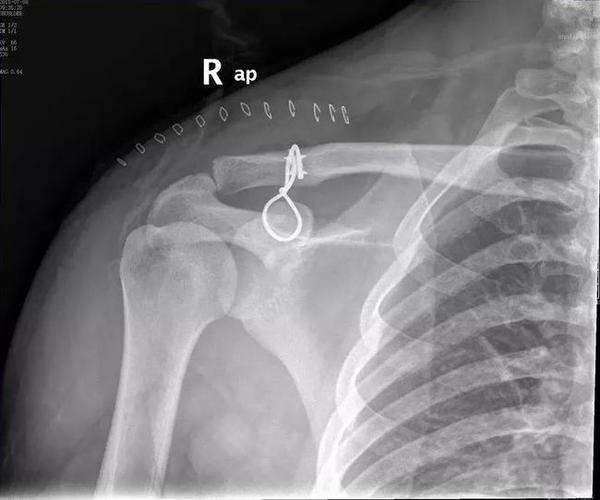 肩锁关节脱位的分型及治疗值得收藏