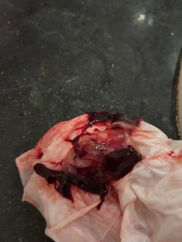 孕囊排出来了还要清宫吗,药流后孕囊排出来了还要清宫