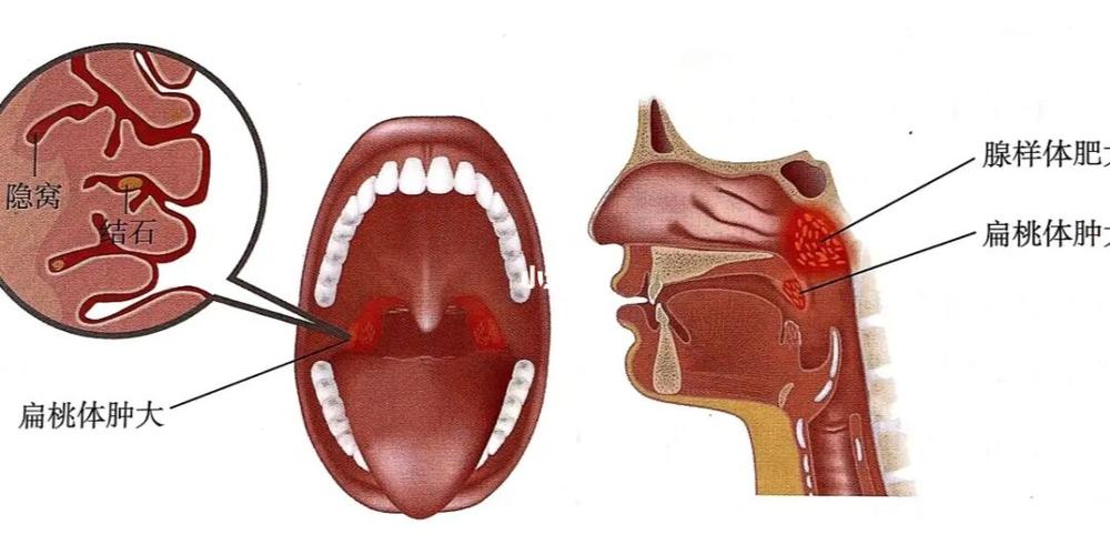 扁桃体和腺样体,你可知是何物_腺样体_扁桃体_腺样体肥大_母婴_育儿