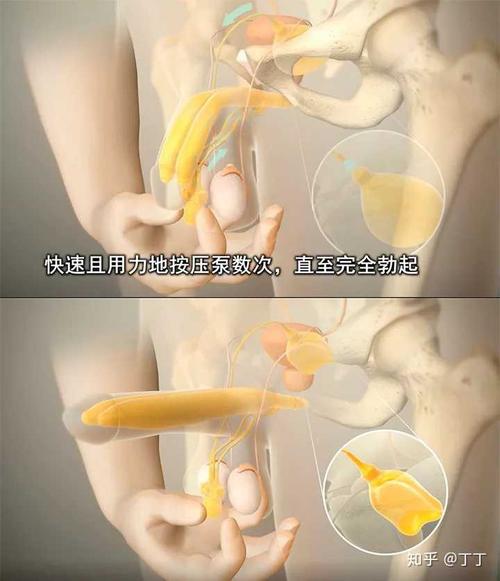 女人可以植入假体丰胸,那男人是否也可以植入什么增大