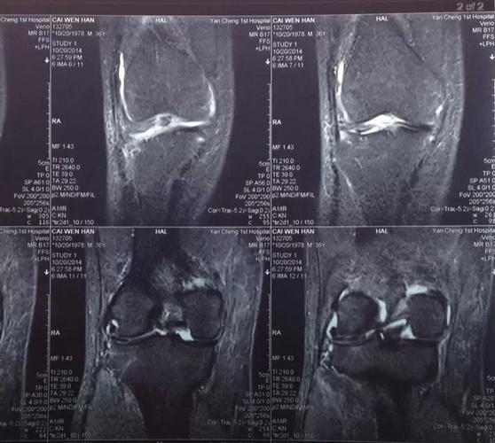 右膝关节外侧半月板损伤,关节腔有积液如果治疗比较好