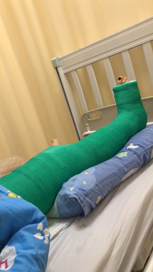 从大腿根到脚趾头的超长石膏