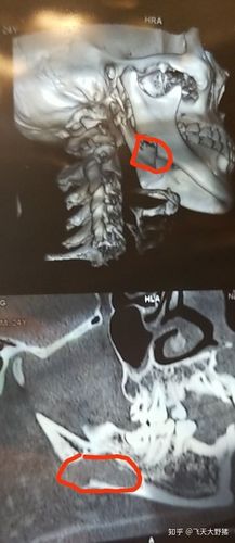 下颌骨肿瘤切除记