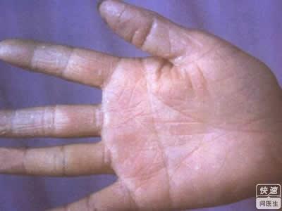 鹅掌风,实际上指的是一种干燥皲裂型的手足癣,形似鹅掌,且瘙痒难忍