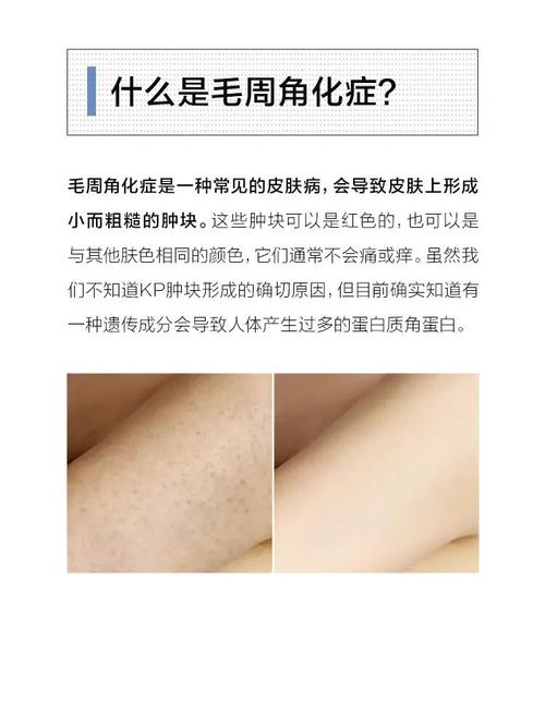 如何解决毛周角化症71_毛周角化_皮肤问题_皮肤光滑