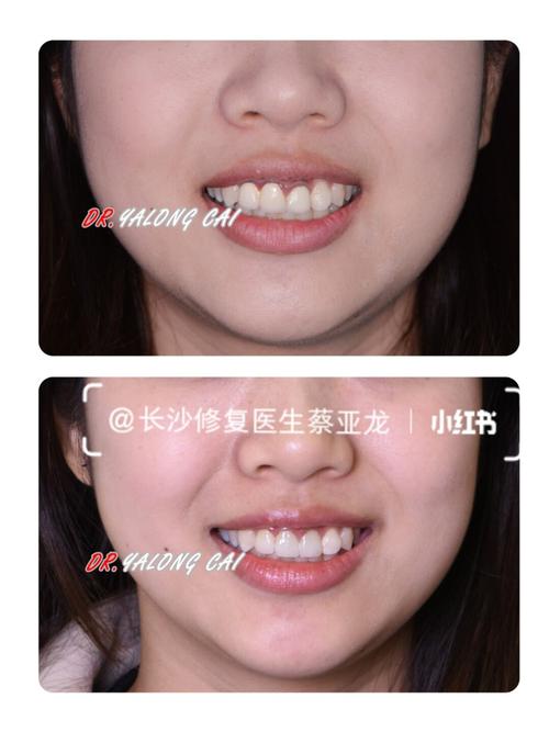 门牙烤瓷冠更换全瓷冠修复,姑娘牙变漂亮了_口腔_钢琴