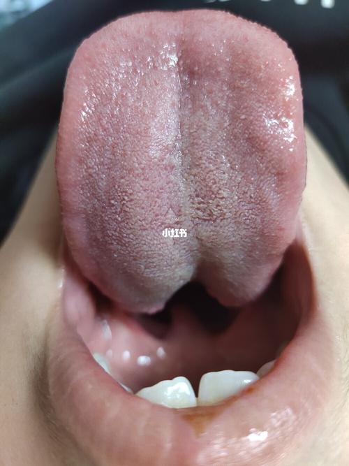 孩子舌头上都是毛刺!_母婴_育儿_母婴_育儿