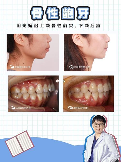 对于龅牙是骨性还是牙性,要看哪里区分?