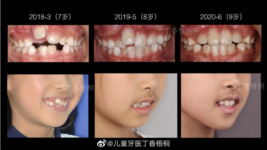 儿童早期牙齿矫正真的有这么重要吗?