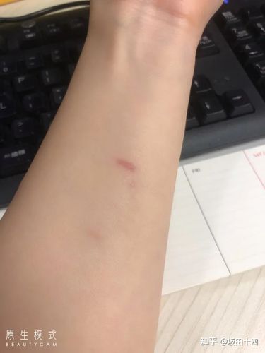 这像不像是狗咬的伤口