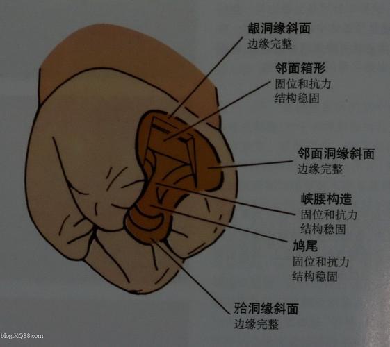 二类洞似的预备方法是比较正规的嵌体预备方式:   窝洞不能有倒凹,洞