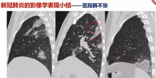 新冠肺炎的影像学表现小结