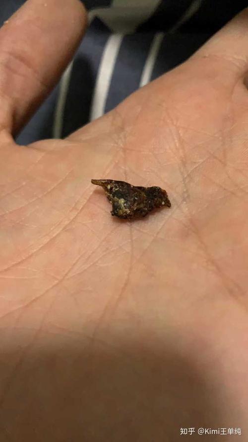 这是2018年11月20日从右耳掏出来的. 两大块铁耳屎跟了我近三十年!