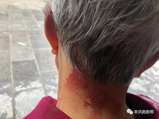 事故造成老人头部受伤流血,身体多处挫伤