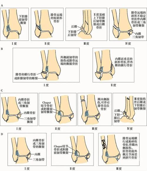 踝关节骨折的常见分型