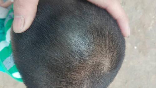 我家宝宝头顶上这块白的是什么?有人说是癣