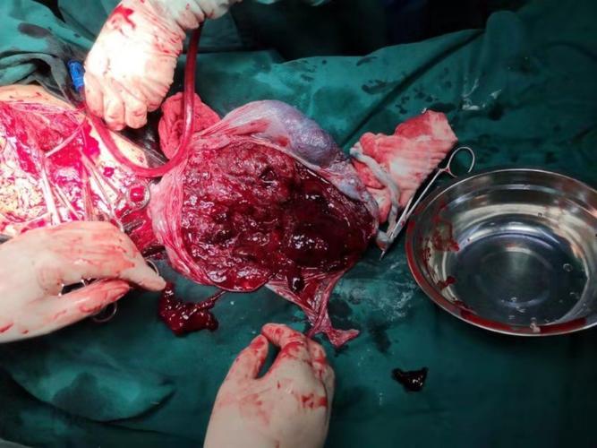 生死营救 写美篇胎盘早剥是指:胎儿在分娩前被剥离称为胎盘早剥