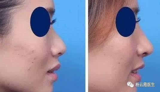 什么情况下适合做鼻基底整形?