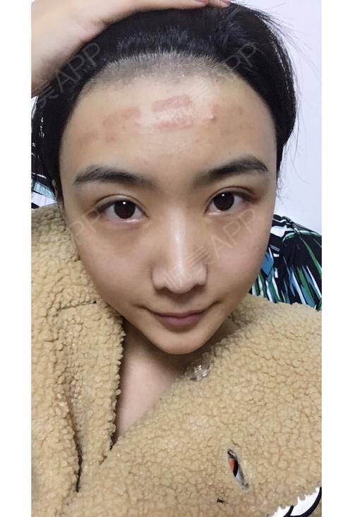 发际线脱毛的地方红红的,且都长出来了额头也过敏了,.