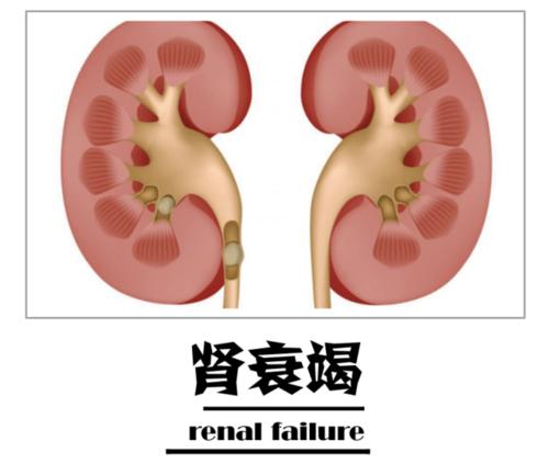 肾衰竭是各种慢性肾脏疾病发展到后期引起的肾功能部分或者全部丧失的