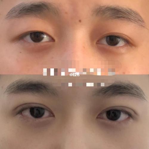 快来get阿lee同款双眼皮|男生双眼皮_双眼皮_lee怎么样_医美_郑州