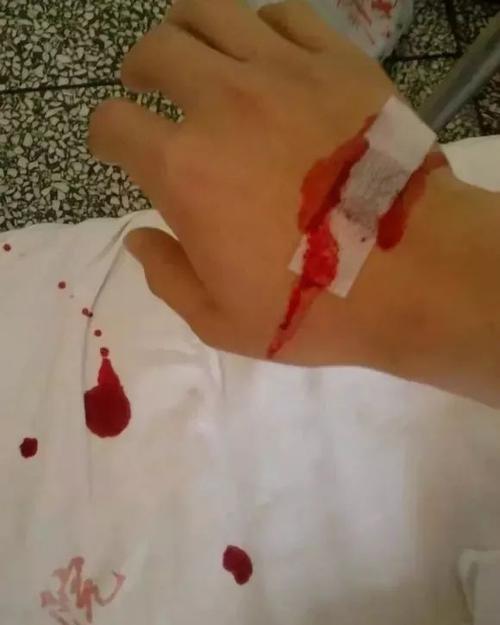 不能关闭,关闭血液会回流)2,大家可以试试反折头皮针前端的输液管拔针