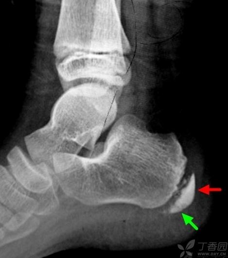 支持大家的意见:跟骨骨骺炎. 表现: 跟骨骨骺密度不均匀增高