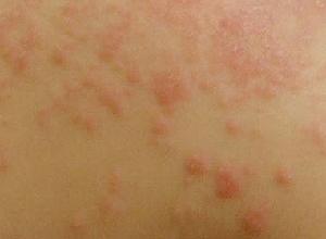 玻璃纤维引起的.