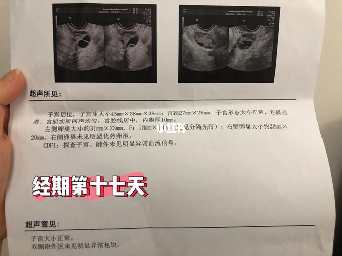 之前都是彩超的,医生说之前应该是没有多憋尿,今天查了卵泡变扁了