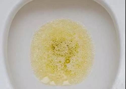 孩子泡沫尿去医院检查显示尿蛋白呈阴性是真没有问题吗?