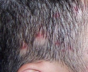 白塞病头皮毛囊炎怎么办