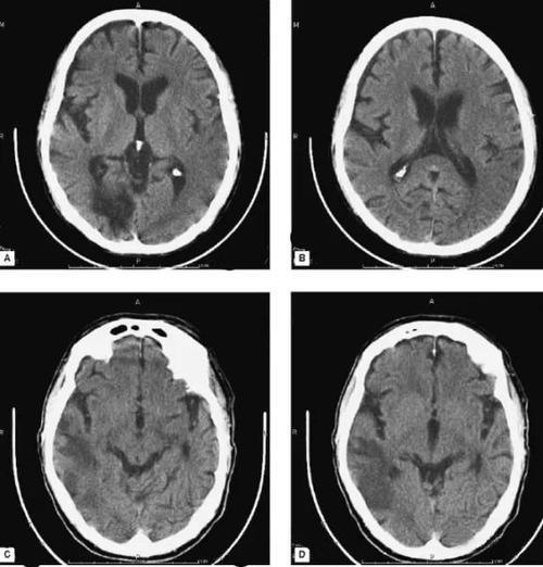 认识这几种头颅 ct,值夜班稳了!|脑积水|出血|脑梗死