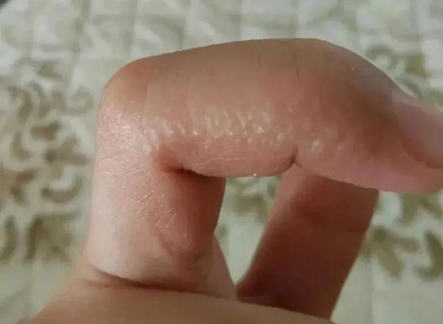 初期的汗疱疹多呈小水泡或丘疱疹样,并伴随瘙痒感,但在1-2周的时间后