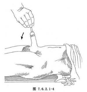 【尿道扩张术】尿道扩张术手术详细步骤,尿道扩张术手术过程