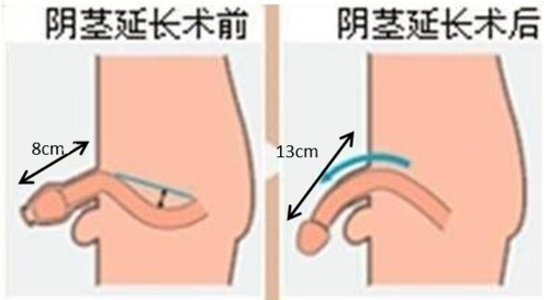 好大夫在线 史建华 > 增大,增粗,不是梦——阴茎延长增粗术 手术适应