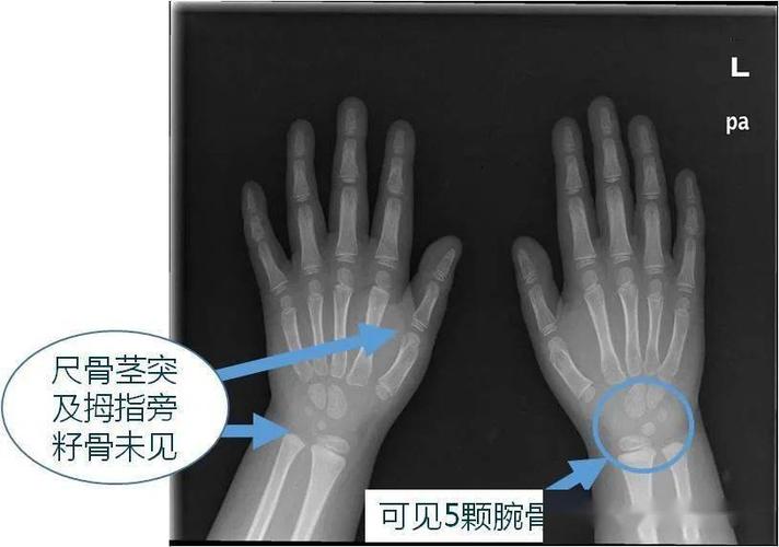 聊聊mccune-albright 综合征那些事儿-搜狐大视野