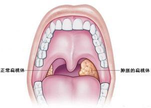 宝宝扁桃体总发炎小儿推拿如何处理