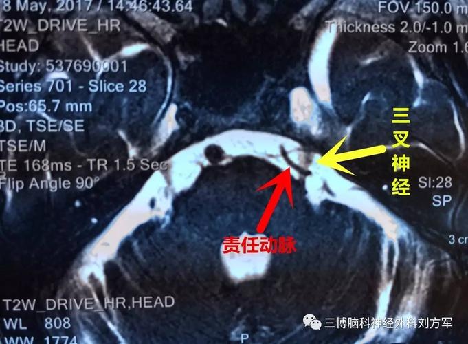 核磁显示:左侧三叉神经及小脑下前动脉关系密切.诊断:左侧三叉神
