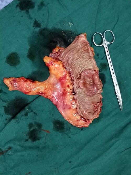 肿瘤手术,做到规范才是最重要的,而不