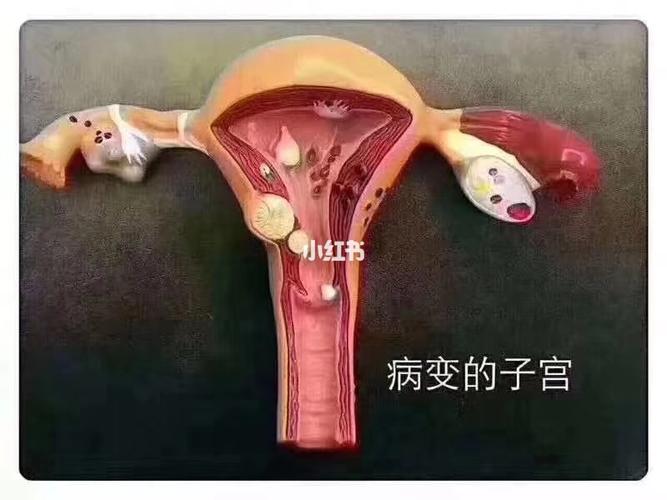 妇科小课堂: 健康的子宫90病变后的子宫 目前有多少人的子宫已经