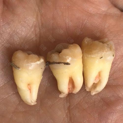 拔了智齿发现这个,这难道是传说中的牙结石吗?