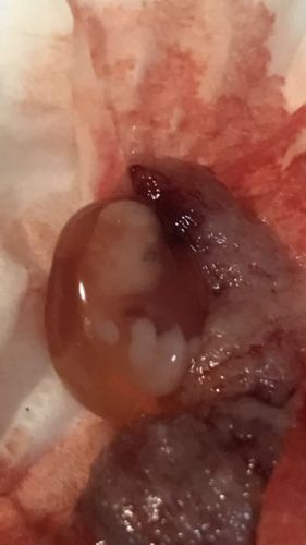 请问一下我怀孕九周3了昨天突然就流产了是什么原因啊